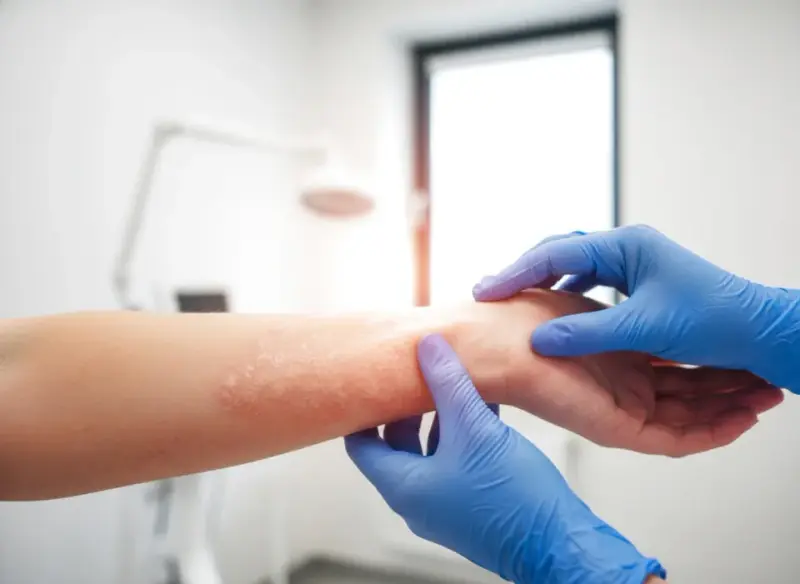 Terapia biologiczna w leczeniu łuszczycy: dla kogo?